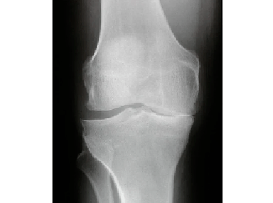 Diagnóstico de artrose da articulação do joelho
