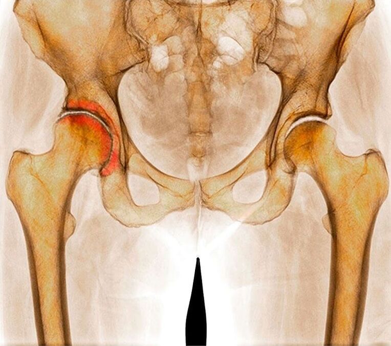 Artrose da articulação do quadril