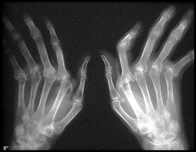 Picture X -Ray das mãos afetadas pela artrose