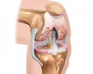 o estágio inicial da artrose do joelho