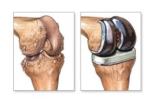 substituição do joelho para artrose