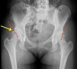 Métodos para o tratamento da artrose da articulação do quadril