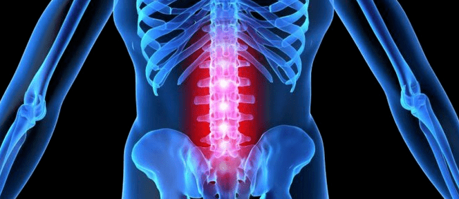 Deformação do disco intervertebral