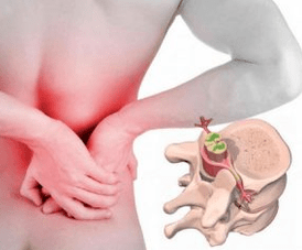 Lumbago no início da doença da doença osteocondrose