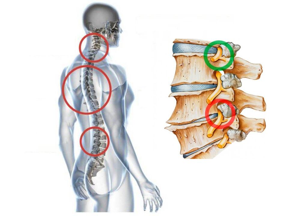 Como é a osteocondrose cervical das vértebras