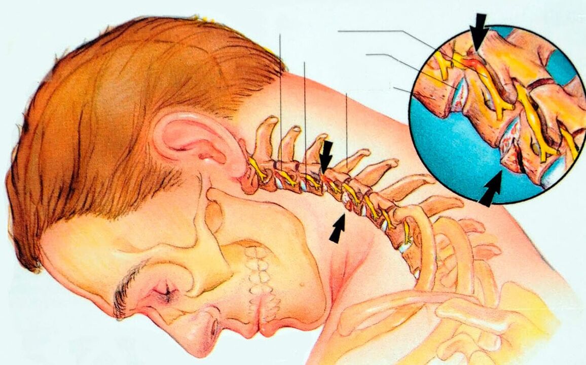 O que é osteocondrose cervical
