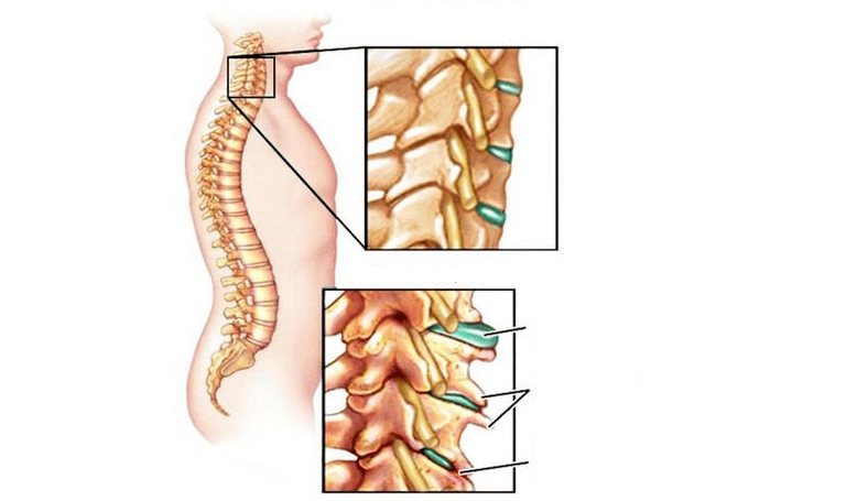 Síndromes de osteocondrose