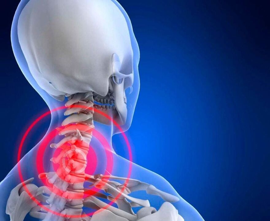 dor no pescoço com osteocondrose cervical