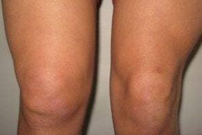 inflamação na articulação do joelho com artrite e artrose
