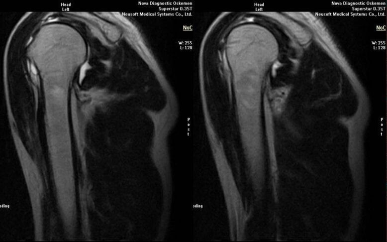 artrose da articulação do ombro na radiografia