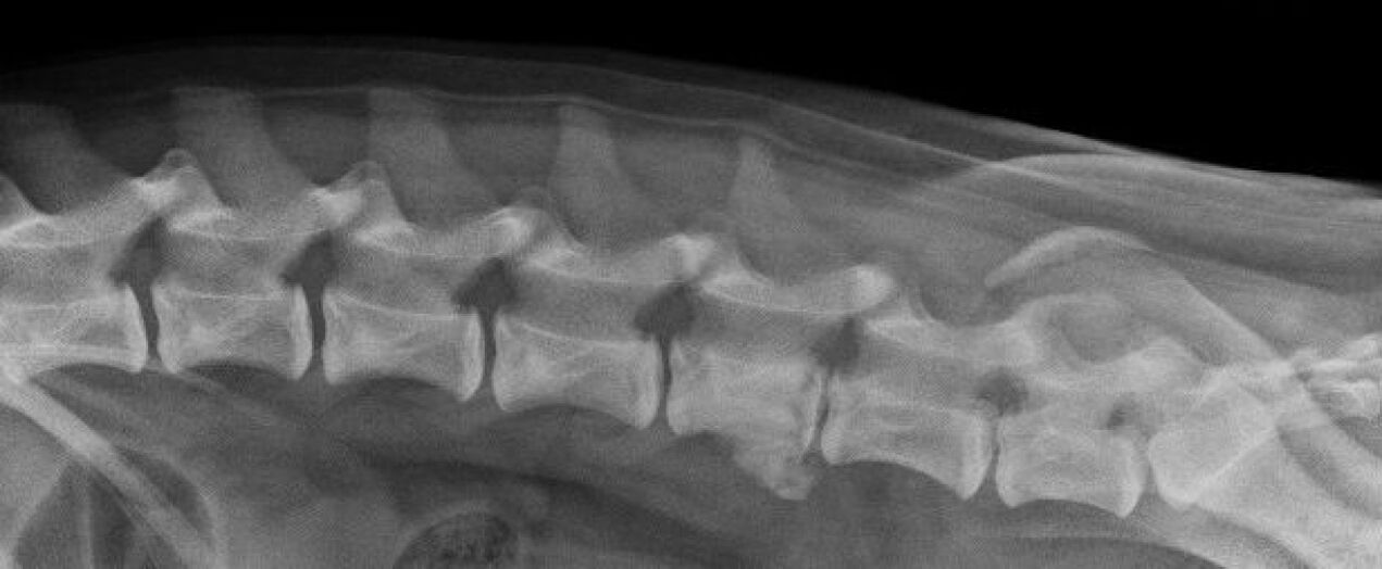 Manifestações de osteocondrose da coluna torácica em uma radiografia