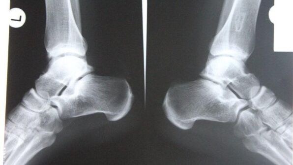 Diagnóstico de artrose do tornozelo por meio de radiografia