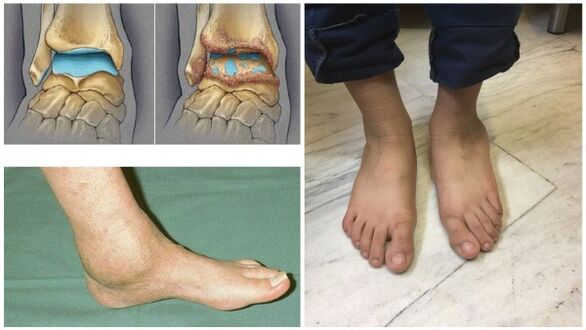 Inchaço e deformação da articulação do tornozelo devido à artrose