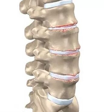 Osteocondrose